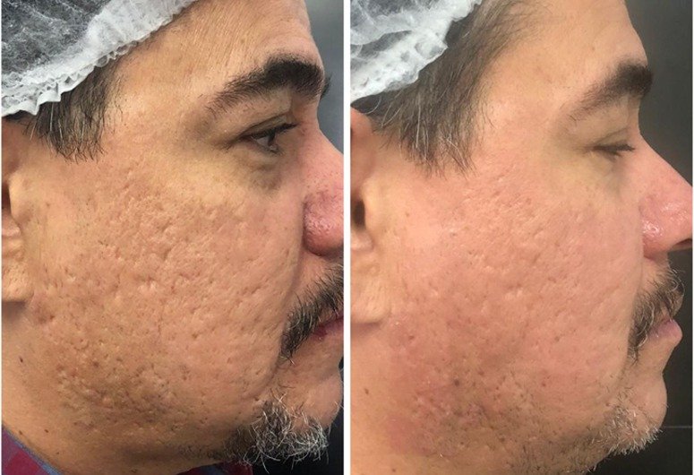 Caso Clínico Cicatriz de Acne com Laser de CO2